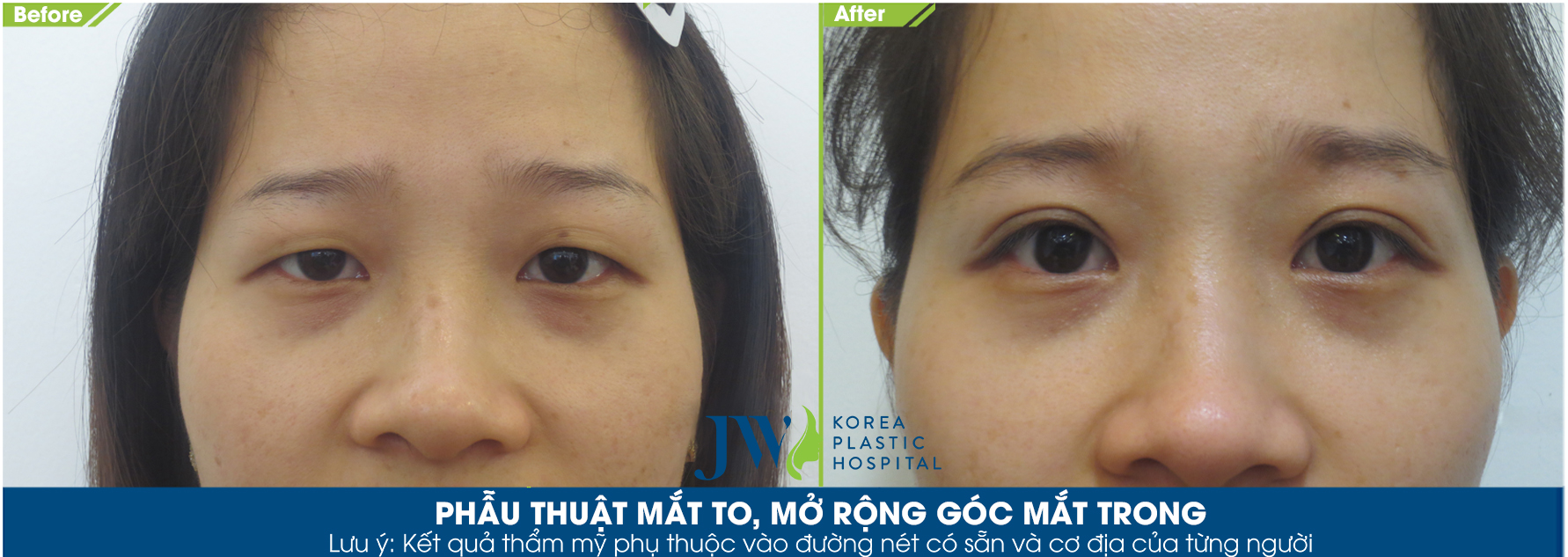 Làm sao để tránh những biến chứng khi cắt mí mắt