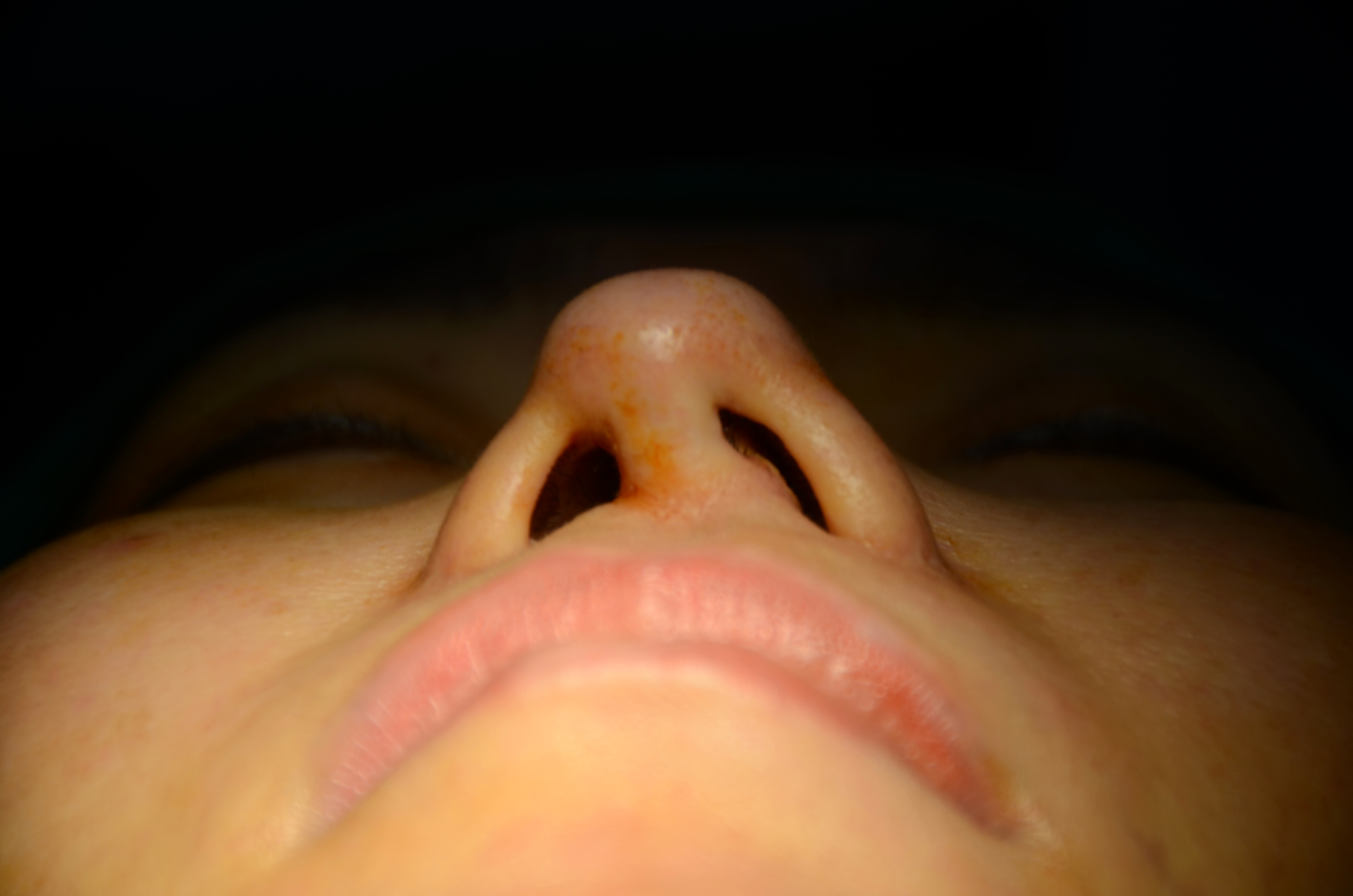 Vẹo trụ vách ngăn mũi sau 5 lần phẫu thuật hỏng
