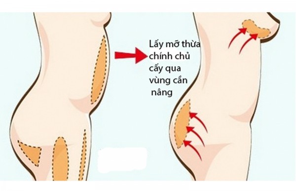 Nâng ngực tự nhiên không phẫu thuật