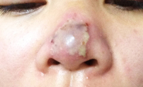 Dấu hiệu nhiễm trùng sau khi nâng mũi khiến bệnh nhân khó chịu