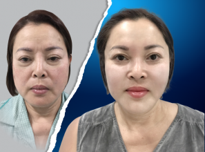 Bảng giá căng da mặt