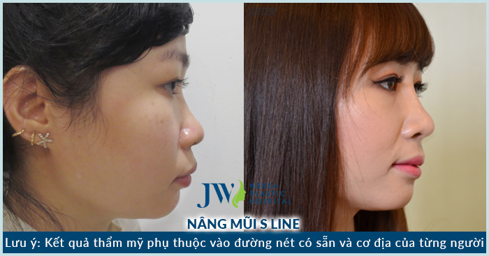Chị Nguyễn Ly Ly tự tin hơn với chiếc mũi mới được chỉnh sửa