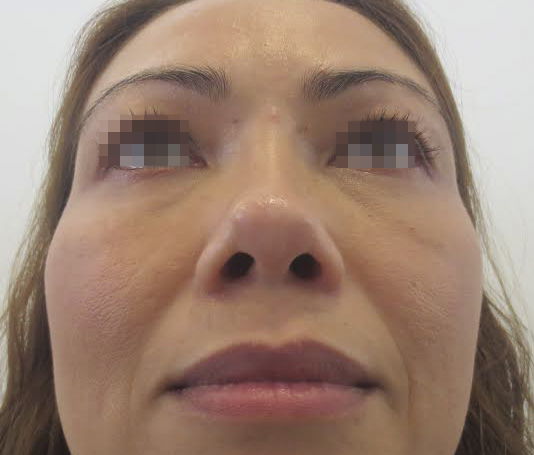 Chuyên khoa tái phẫu thuật thẩm mỹ mũi