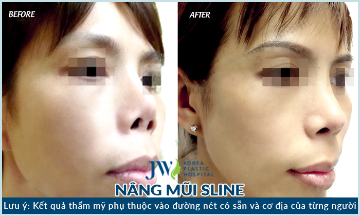 Mũi bị co rút, biến dạng đã được khắc phục nhờ nâng mũi S line tại JW