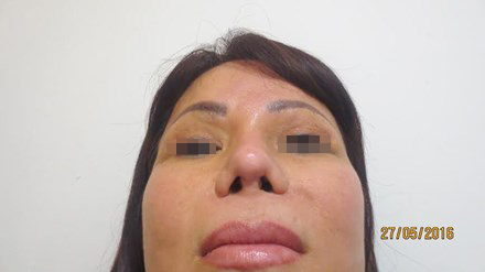Chuyên khoa tái phẫu thuật thẩm mỹ mũi