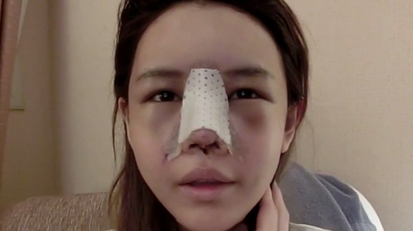 chuyên khoa tái thẩm mỹ mũi chuẩn Hàn