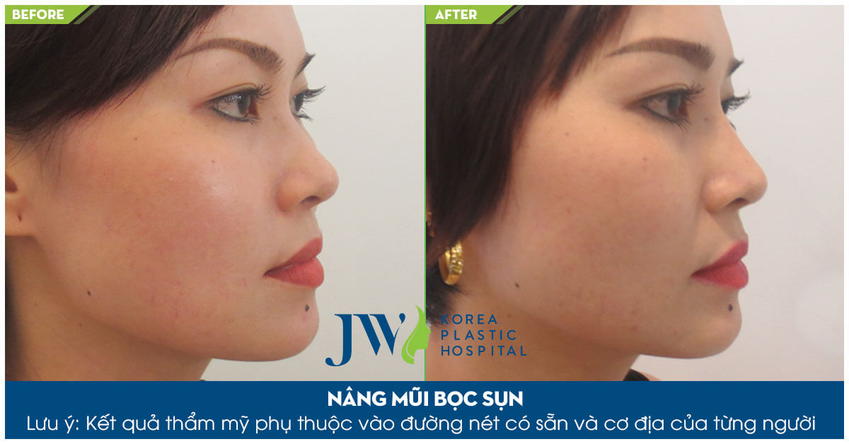 So sánh sửa mũi bọc sụn với nâng mũi S Line - Ảnh 6