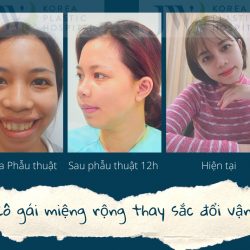 Phẫu Thuật Miệng Rộng: Phẫu Thuật Thu Nhỏ Miệng Rộng (Không Đau)