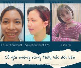 Phẫu Thuật Miệng Rộng: Phẫu Thuật Thu Nhỏ Miệng Rộng (Không Đau)