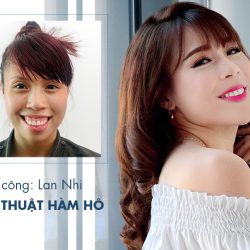 Chùm ảnh “biến hóa” hoàn hảo của 10 cô gái sau phẫu thuật hàm hô