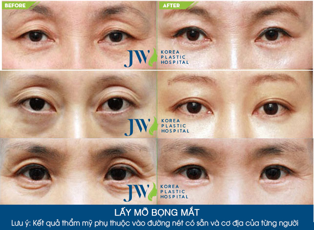 Chỉ 30 phút lấy mỡ bọng mắt - Mắt đẹp trẻ hóa-3