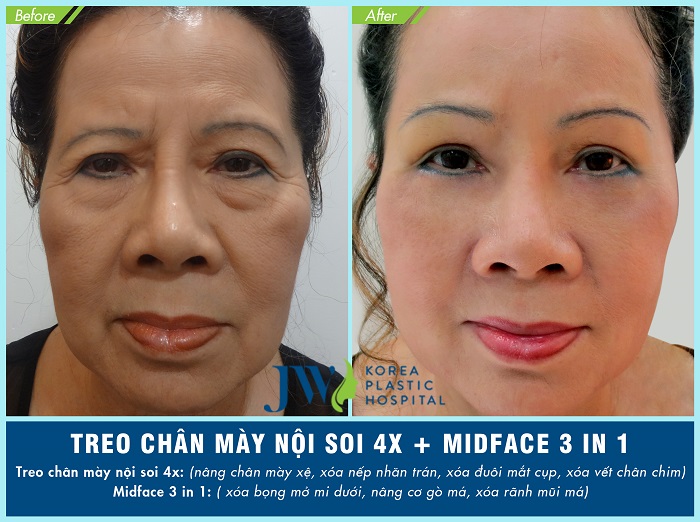 Treo chân mày nội soi
