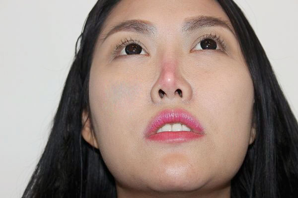 Thủng da đầu mũi – Nguyên nhân và cách khắc phục hiệu quả - Bệnh viện thẩm  mỹ JW Hàn Quốc