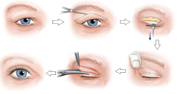 Bị sụp mí mắt khắc phục