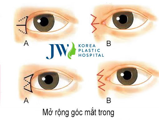 phẫu thuật mắt to là làm gì