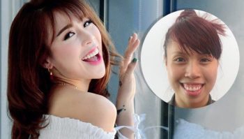 Chi phí phẫu thuật hàm hô nói lên chất lượng thẩm mỹ