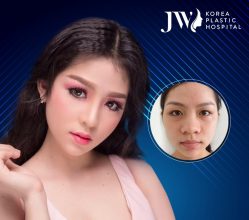 Nhờ nâng mũi cô gái trở thành hotgirl gây xôn xao