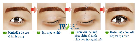quy trình nhấn mí mắt 