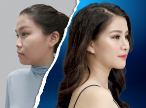 Bảng giá phẫu thuật nâng mũi