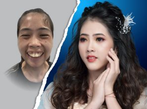 Hàm Mặt Hô Móm: Bảng Giá Phẫu Thuật Hàm Mặt JW