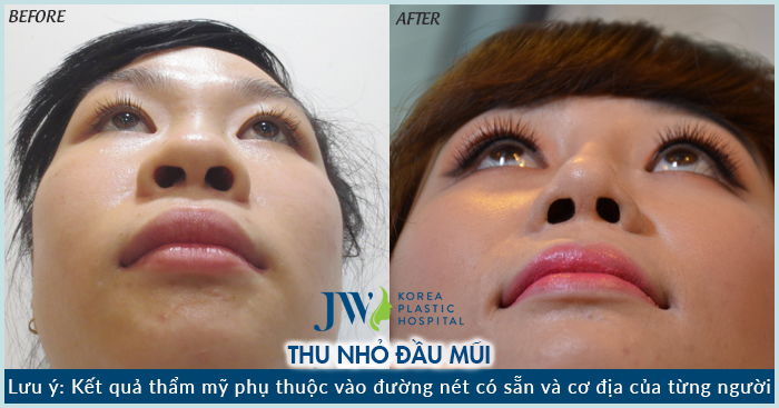 thu gọn đầu mũi 