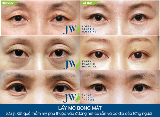 lấy mỡ bọng mắt