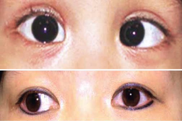 phẫu thuật mắt lác