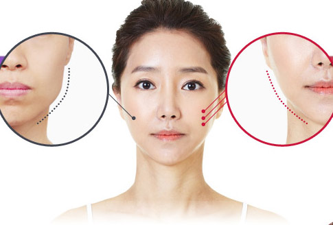 quá trình gọt cằm v line