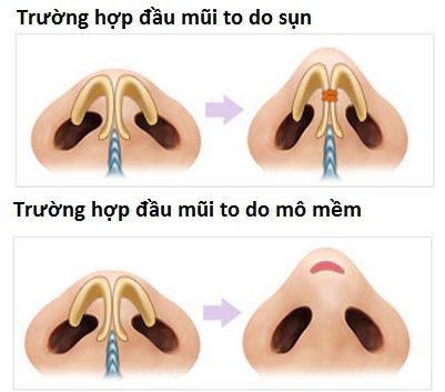 thu gọn cánh mũi