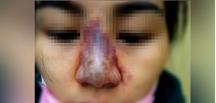 Nhận biết các dấu hiệu nhiễm trùng sau khi nâng mũi và cách điều trị - Ảnh 2