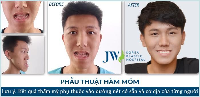 phau-thuat-ham-mom-6