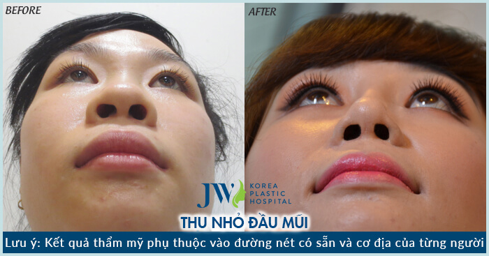 Thu gọn đầu mũi