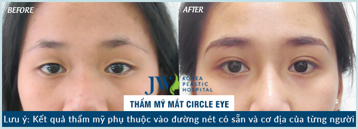 Phẫu thuật mắt to