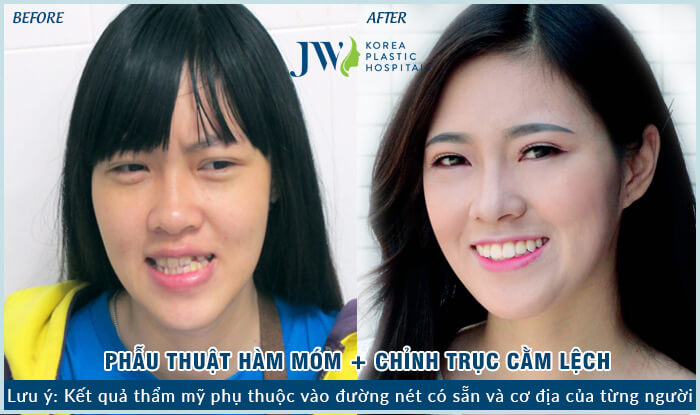 phau-thuat-ham-mom-5