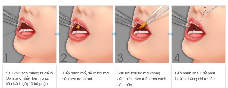 lấy túi mỡ má