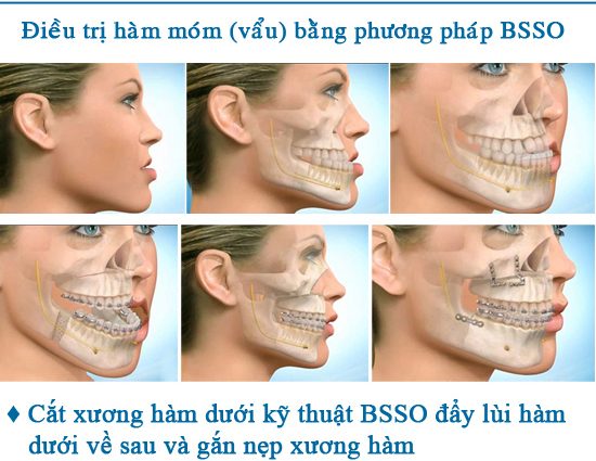 phau-thuat-ham-mom-2