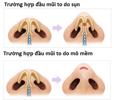 thu gọn đầu mũi,