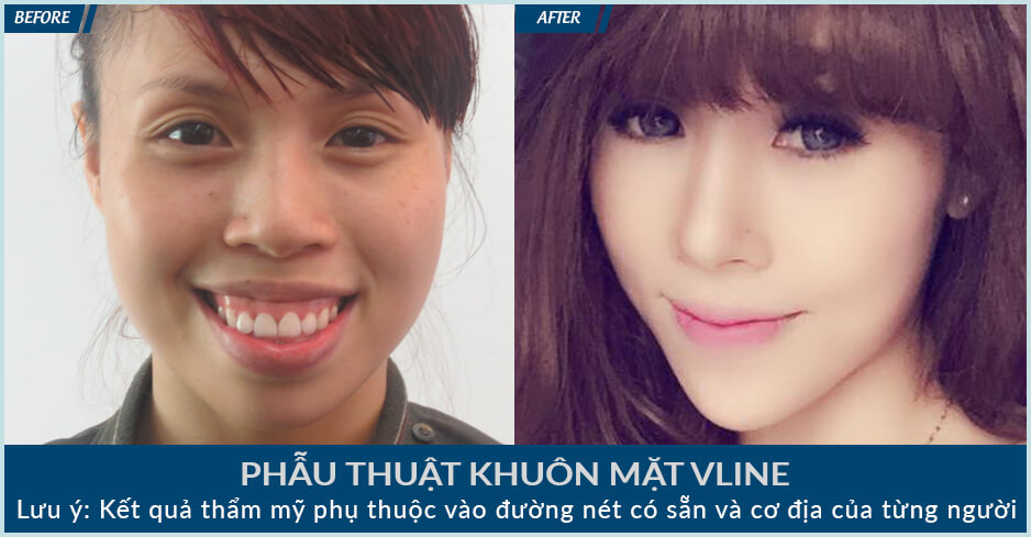 gọt mặt v line