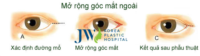 phau-thuat-mat-to-3