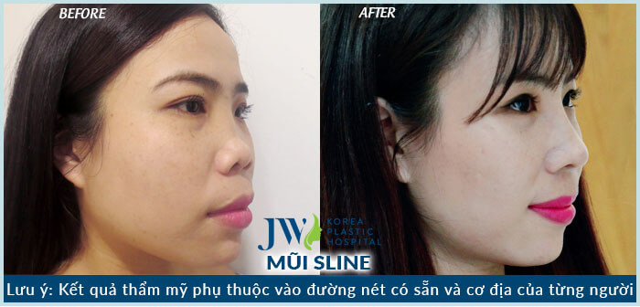 nâng mũi hàn quốc