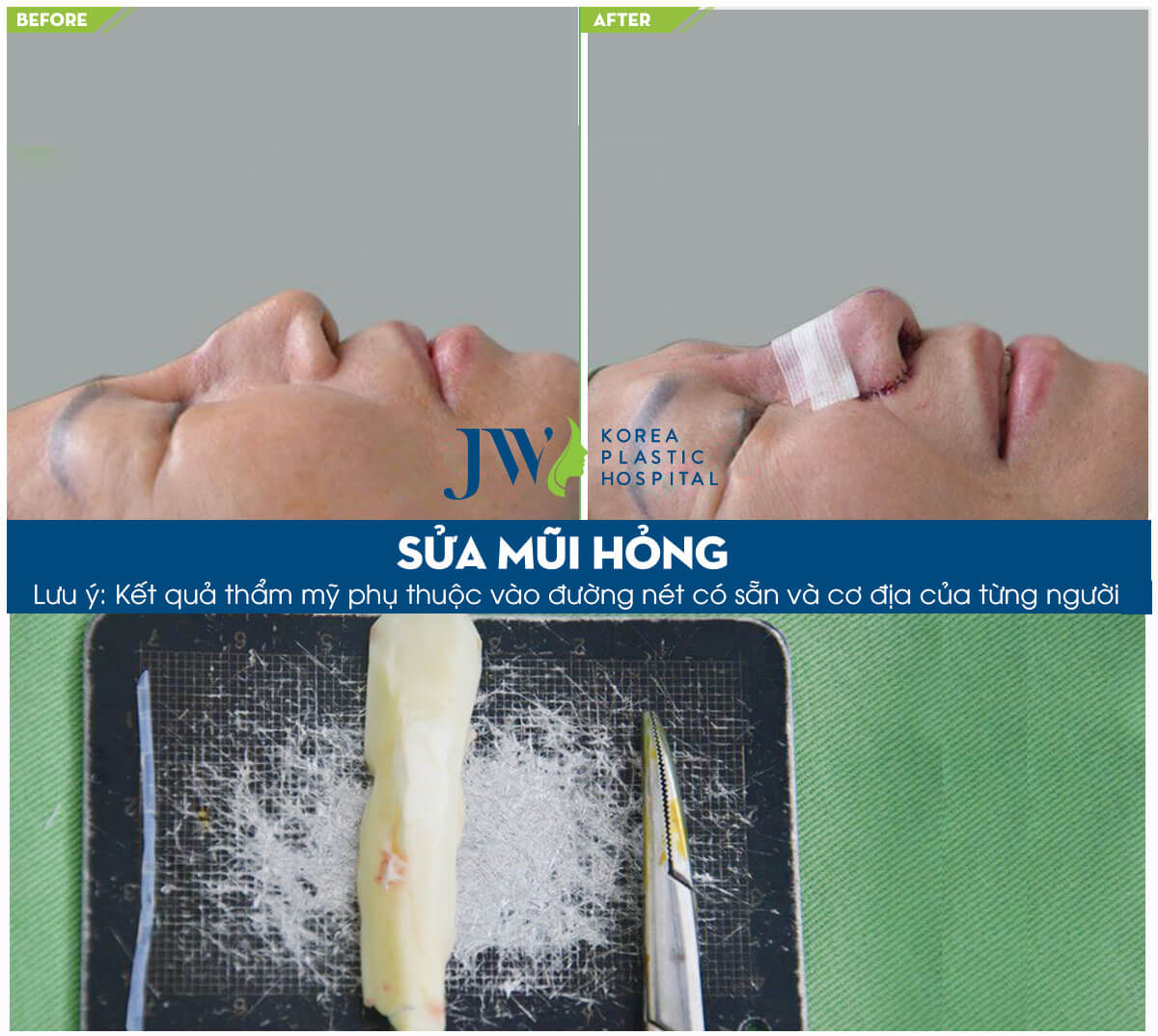 dau-hieu-nhiem-trung-sau-khi-nang-mui-3