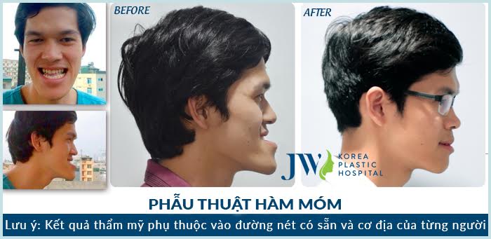 Phẫu thuật hàm móm