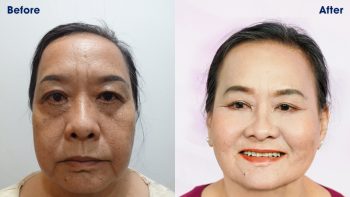 Đặt niềm tin sai chỗ, cô Thúy Hồng bị lật mi dưới sau khi thẩm mỹ