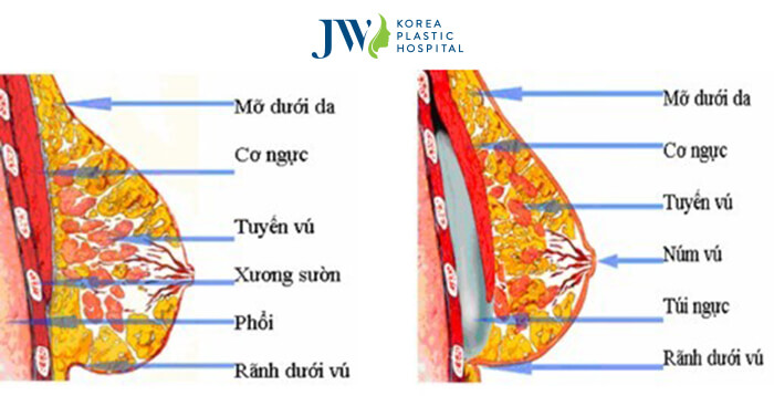 Nâng ngực nội soi có đau không - Những điều cần biết về thẩm mỹ ngực- Ảnh 3