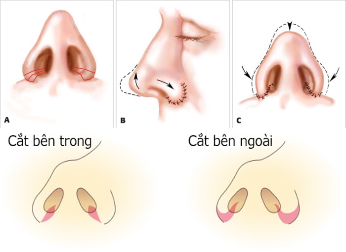 Thu gọn cánh mũi và đầu mũi – 6 điều quan trọng cần rõ-hình 2