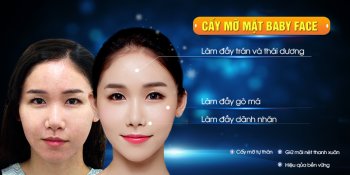 Cấy mỡ mặt Baby Face – Trẻ hóa toàn diện, bền vững 10 năm