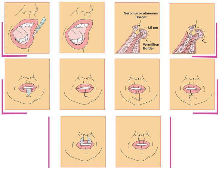 Thẩm mỹ môi - Bí quyết cho bờ môi quyến rũ tự nhiên - Ảnh 2