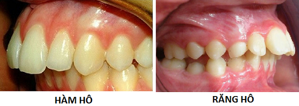 Niềng răng có hết hô hàm không – 5 điều quan trọng cần biết-hình 2