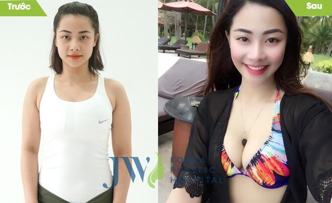 Nâng ngực bằng túi giọt nước Demi-hình 8