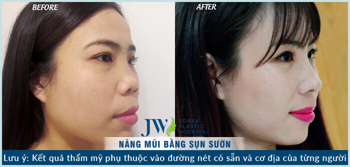 Nâng mũi bằng sụn sườn-hình 8